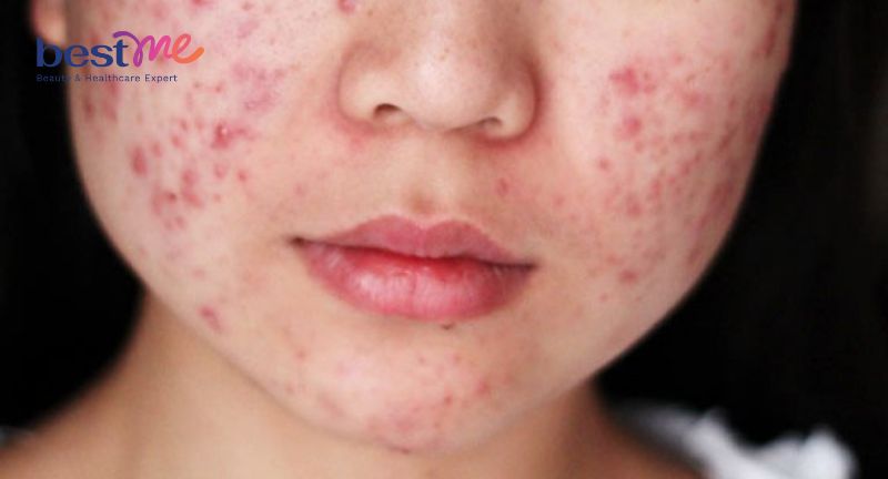Nguyên nhân tự nhiên nổi mụn nước ở mặt và cách trị hiệu quả
