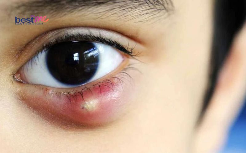 Có những triệu chứng và biểu hiện nào của mụn nước ở mí mắt?
