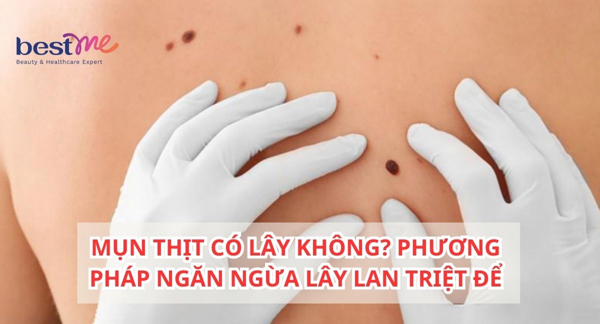 Giải đáp mụn thịt có lây không? Có lan trên cơ thể không?