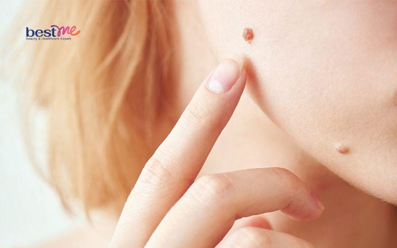 Mụn thịt ở trẻ em có nguy hiểm không? Cách chữa trị hiệu quả - 2