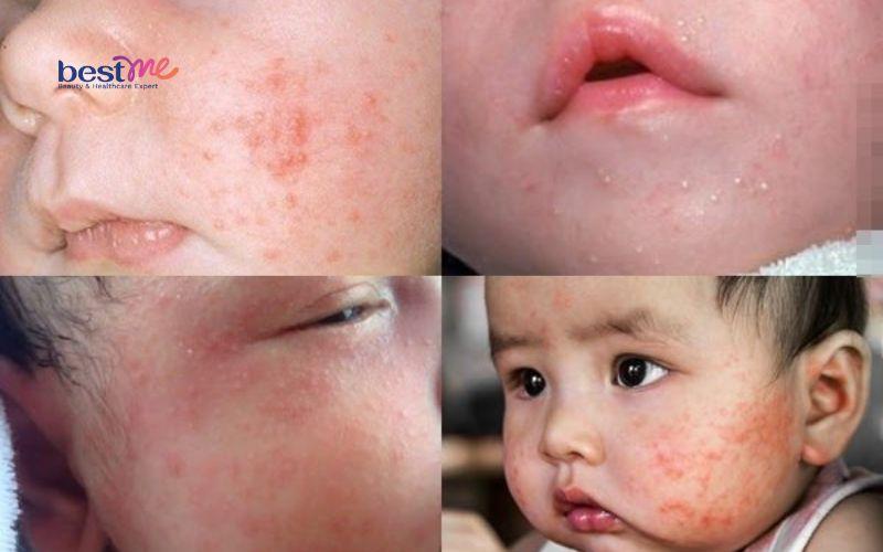 Mụn thịt ở trẻ em có nguy hiểm không? Cách chữa trị hiệu quả - 3