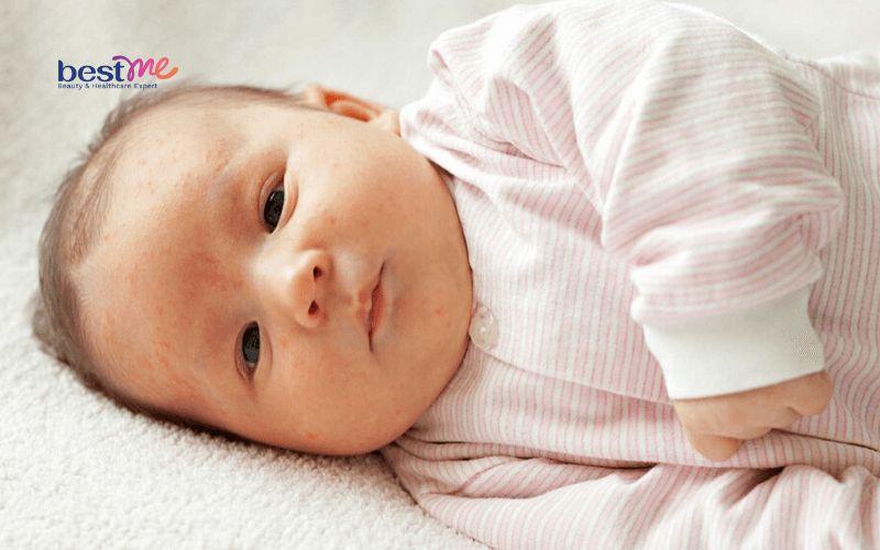 Mụn thịt ở trẻ em có nguy hiểm không? Cách chữa trị hiệu quả - 4