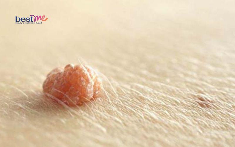 Mụn thịt ở trẻ em có nguy hiểm không? Cách chữa trị hiệu quả - 7