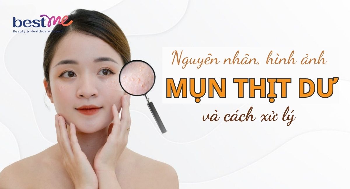 Nguyên nhân, hình ảnh mụn thịt dư và cách xử lý hiệu quả nhất