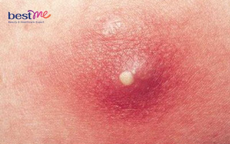 Mụn trứng cá là gì? Hình ảnh, nguyên nhân, các loại thường gặp - 6