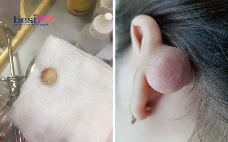 mun-u-ba-dau-la-gi-co-nguy-hiem-khong-co-tu-het-khong-3 Mụn u bã đậu là gì? Có nguy hiểm không? Có tự hết không? - 3
