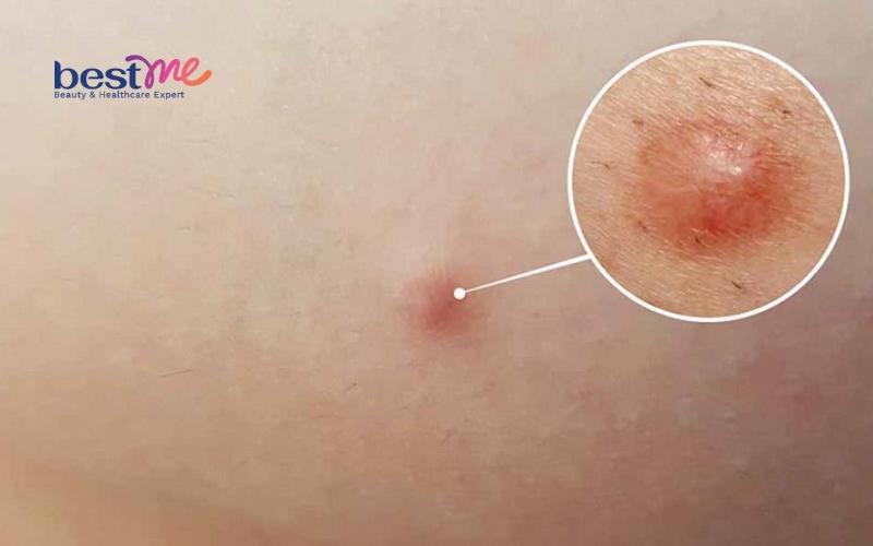 mun-u-ba-dau-o-tai-co-tu-het-khong-cach-tri-hieu-qua-nhat-1 Mụn u bã đậu ở tai có tự hết không? Cách trị hiệu quả nhất - 1