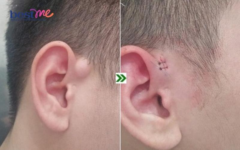 mun-u-ba-dau-o-tai-co-tu-het-khong-cach-tri-hieu-qua-nhat-7 Mụn u bã đậu ở tai có tự hết không? Cách trị hiệu quả nhất - 7