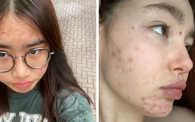 Làn da tuổi dậy thì thường gặp vấn đề về mụn