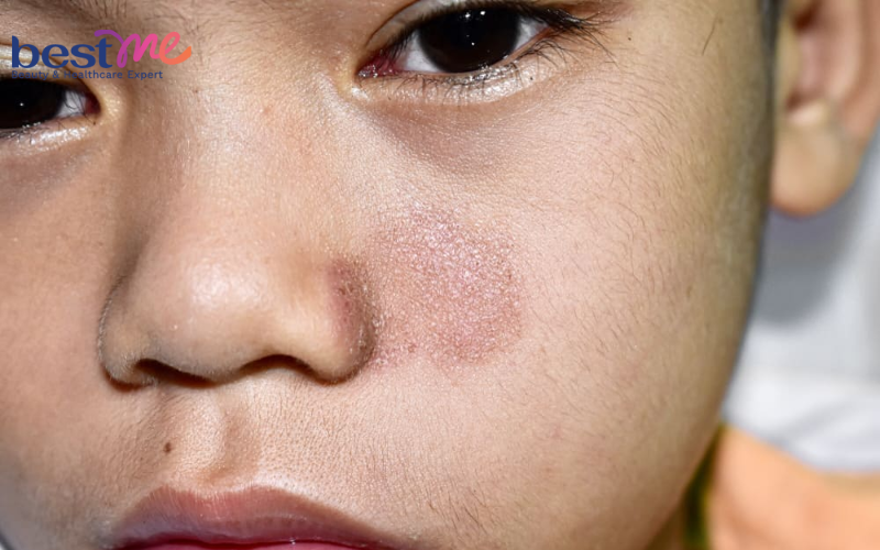 Bệnh nấm da mặt : Nguyên nhân, hình ảnh, điều trị hiệu quả