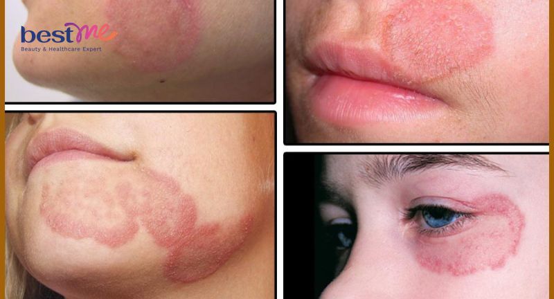 Nấm da mặt có nguy hiểm không và cách điều trị?