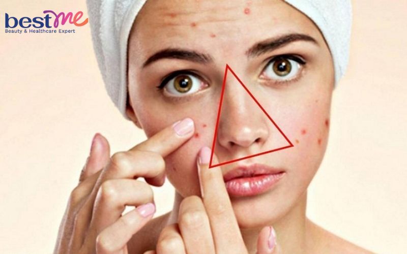 nan-mun-dinh-rau-meo-mom-phai-lam-sao-cach-xu-ly-tot-nhat-2 Nặn mụn đinh râu méo mồm phải làm sao? Cách xử lý tốt nhất - 2