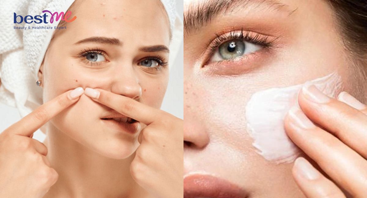 Giải đáp mới nặn mụn xong có nên bôi kem chống nắng không?