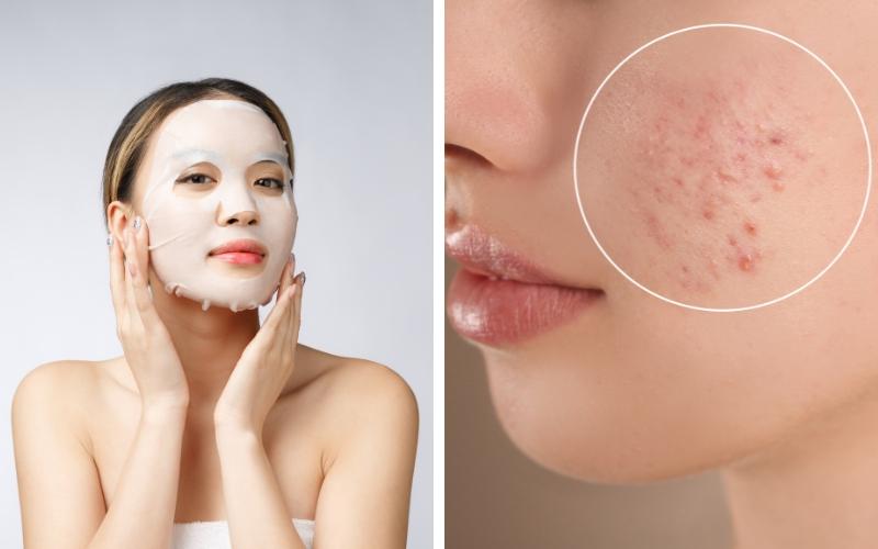 nan-mun-xong-co-nen-dap-mat-na-huong-dan-dap-mat-na-tot-nhat-4 Nặn mụn xong có nên đắp mặt nạ? Hướng dẫn đắp mặt nạ tốt nhất - 4