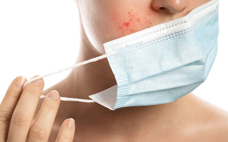 nan-mun-xong-co-nen-rua-mat-khong-nen-rua-mat-bang-gi-2 Nặn mụn xong có nên rửa mặt không? Nên rửa mặt bằng gì? - 2