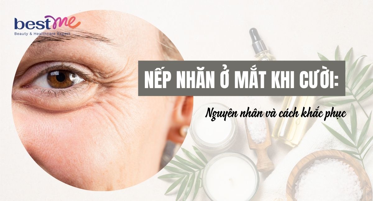 Nếp nhăn ở mắt khi cười: Nguyên nhân và cách khắc phục