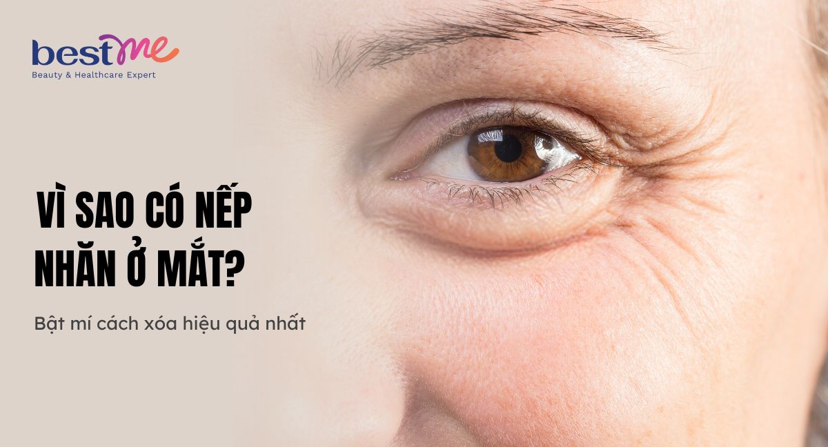 Vì sao có nếp nhăn ở mắt? Bật mí cách xóa hiệu quả nhất