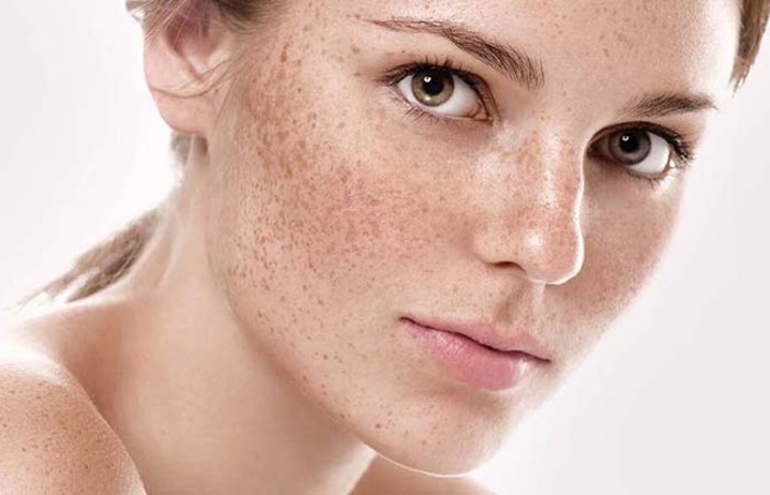 Lão hóa da là một trong những nguyên nhân phổ biến gây nên thâm nám da