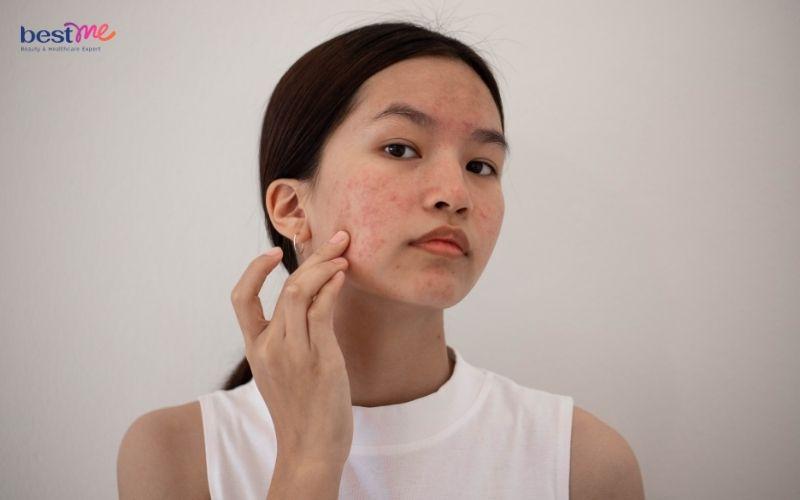 nguyen-nhan-bi-mun-viem-do-o-ma-va-cach-dieu-tri-hieu-qua-2 Nguyên nhân bị mụn viêm đỏ ở má và cách điều trị hiệu quả - 2
