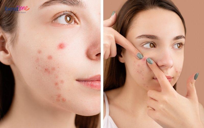 nguyen-nhan-bi-mun-viem-do-o-ma-va-cach-dieu-tri-hieu-qua-6 Nguyên nhân bị mụn viêm đỏ ở má và cách điều trị hiệu quả - 6