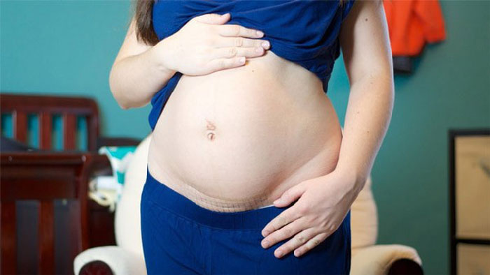 Tại sao cần kết hợp chế độ ăn uống và luyện tập để giảm mỡ bụng sau sinh mổ?
