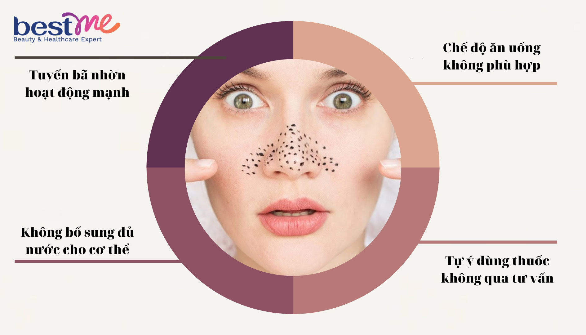 Các nguyên nhân chủ yếu gây ra mụn đầu đen