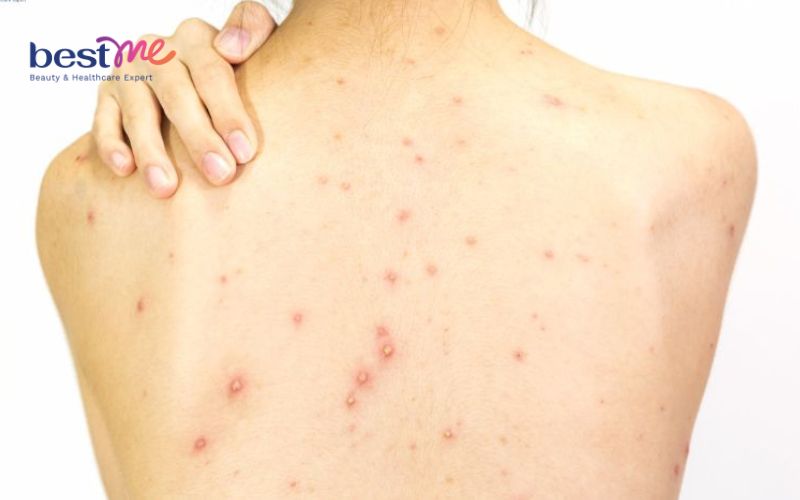 nguyen-nhan-gay-mun-trung-ca-o-lung-va-cach-dieu-tri-tot-nhat-5 Nguyên nhân gây mụn trứng cá ở lưng và cách điều trị tốt nhất - 5