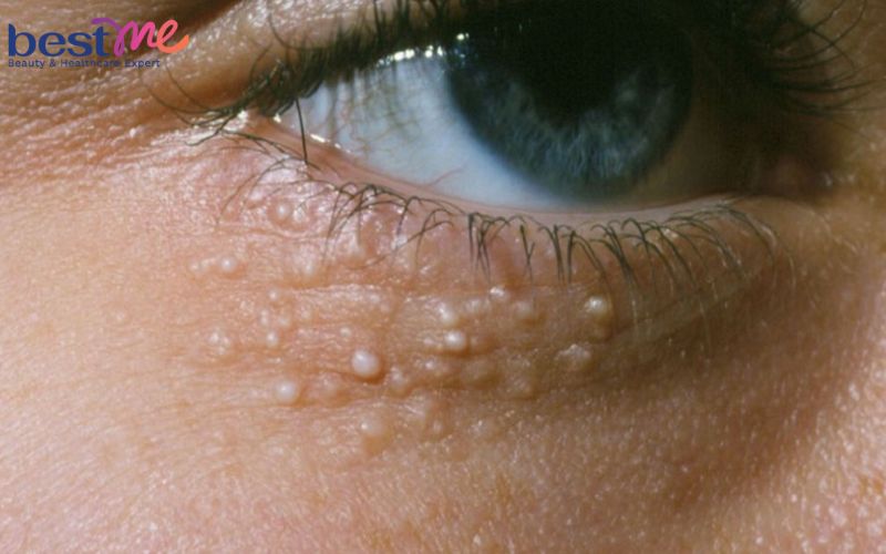 nguyen-nhan-hinh-anh-mun-thit-du-va-cach-xu-ly-hieu-qua-nhat-3 Nguyên nhân, hình ảnh mụn thịt dư và cách xử lý hiệu quả nhất - 3