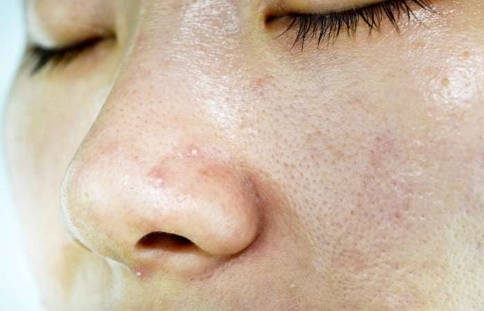 Chăm sóc da không đúng cách khiến da đổ dầu và nổi mụn