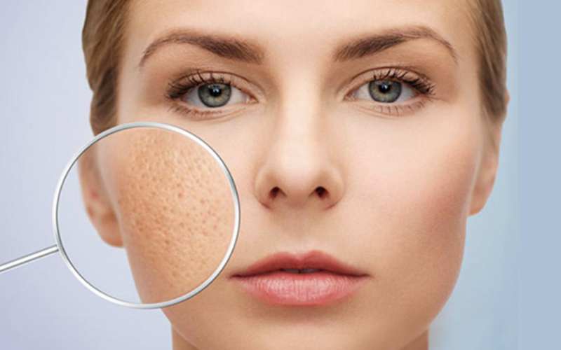 Nguyên nhân và phương pháp phục hồi da mặt bị rỗ tại nhà an toàn - 1