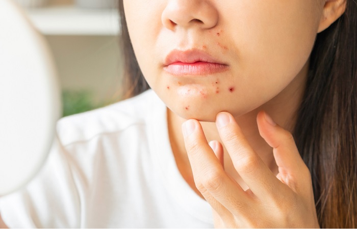 Nổi mụn ở da khô do mắc các bệnh lý về da