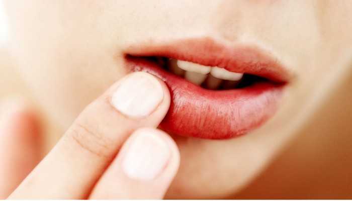 Nguyên nhân môi bị khô nứt nẻ vào mùa hè