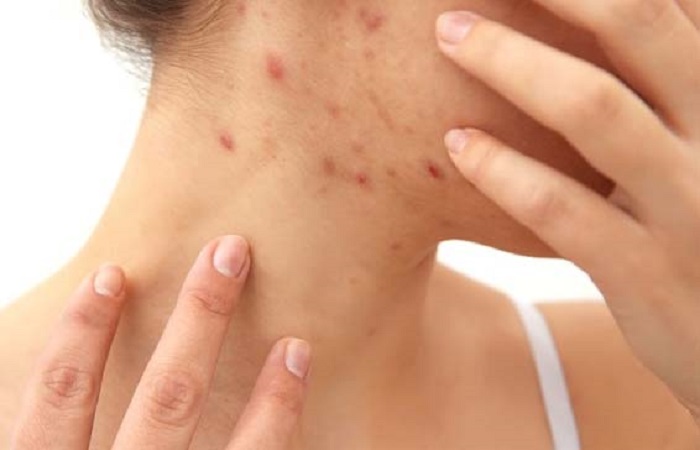 Dấu hiệu nóng gan, nổi mụn ngứa