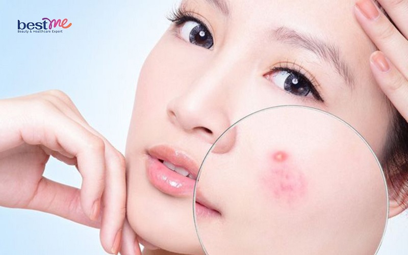 nguyen-nhan-va-7-cach-tri-mun-boc-o-ma-nhanh-hieu-qua-nhat-5 Nguyên nhân và 7 cách trị mụn bọc ở má nhanh hiệu quả nhất - 5
