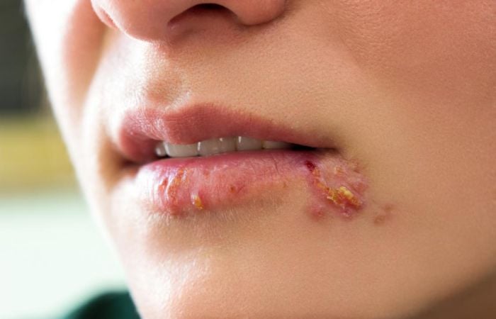 Nhiễm virus Herpes khiến môi khô, mọc mụn rộp
