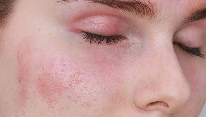 Da nhạy cảm nên chọn kem chống nắng có thành phần tự nhiên