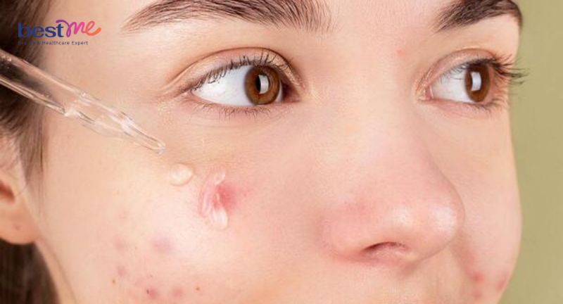 Niacinamide có đẩy mụn không? Chuyên gia da liễu giải đáp