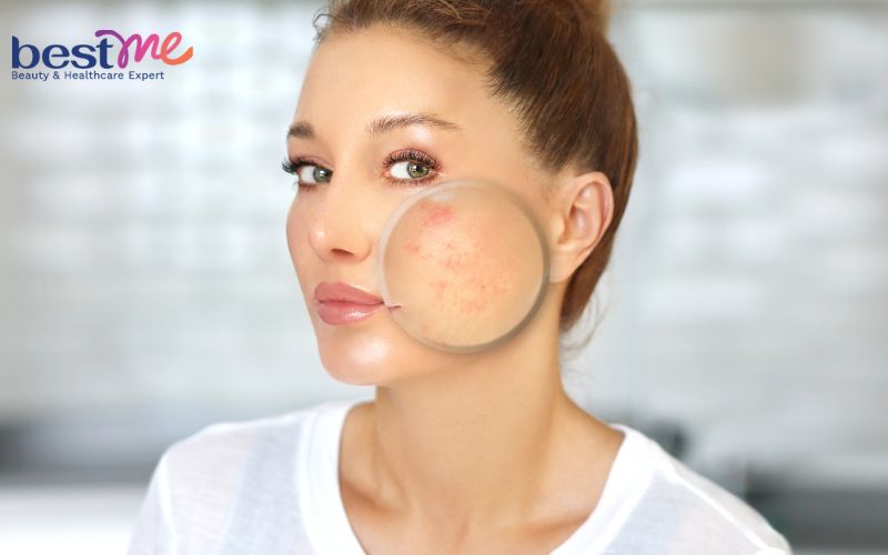 Việc massage dầu quá lâu có thể khiến cặn trang điểm, bụi bẩn thấm ngược trở lại, sinh mụn trên da