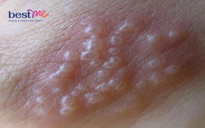 noi-mun-dau-trang-o-vung-kin-o-nu-nam-co-nguy-hiem-khong-1 Nổi mụn đầu trắng ở vùng kín ở nữ, nam có nguy hiểm không? - 1