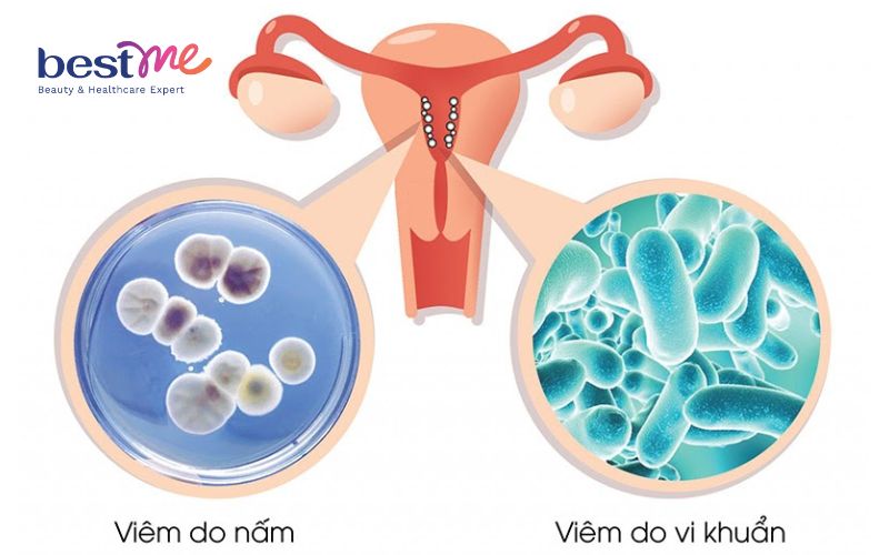 noi-mun-dau-trang-o-vung-kin-o-nu-nam-co-nguy-hiem-khong-3 Nổi mụn đầu trắng ở vùng kín ở nữ, nam có nguy hiểm không? - 3