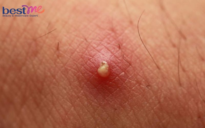 noi-mun-nhot-o-hang-la-benh-gi-cach-dieu-tri-nhanh-nhat-1 Nổi mụn nhọt ở háng là bệnh gì? Cách điều trị nhanh nhất - 1