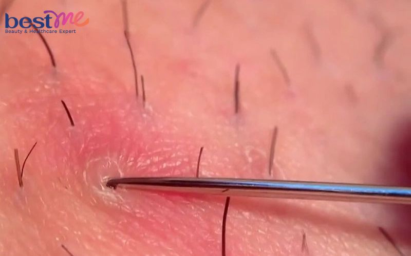 noi-mun-nhot-o-hang-la-benh-gi-cach-dieu-tri-nhanh-nhat-2 Nổi mụn nhọt ở háng là bệnh gì? Cách điều trị nhanh nhất - 2