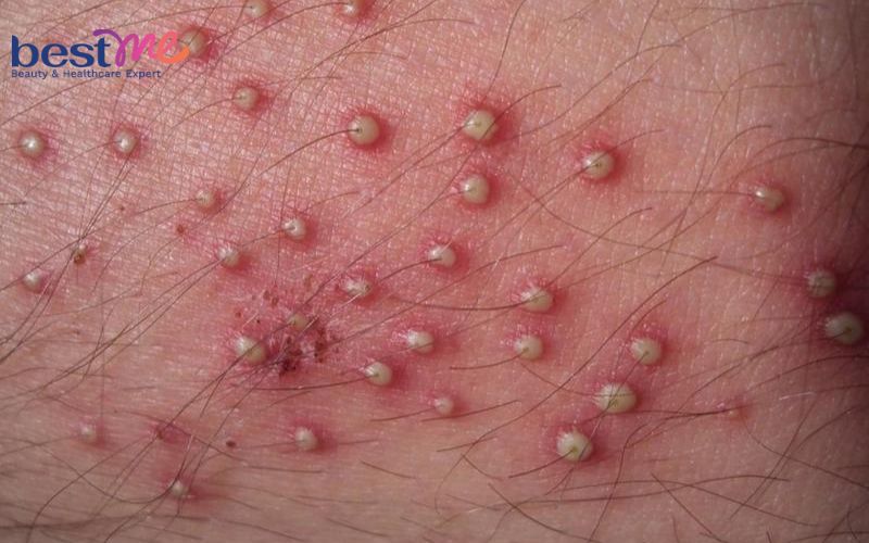 noi-mun-nhot-o-hang-la-benh-gi-cach-dieu-tri-nhanh-nhat-3 Nổi mụn nhọt ở háng là bệnh gì? Cách điều trị nhanh nhất - 3