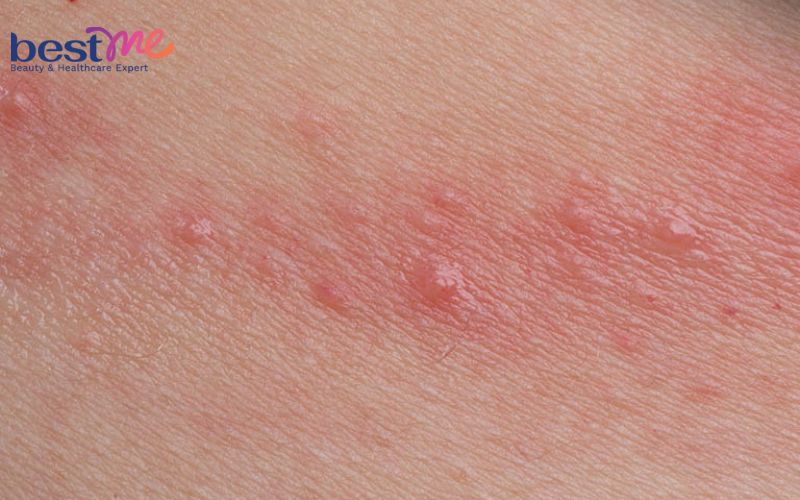 noi-mun-nhot-o-hang-la-benh-gi-cach-dieu-tri-nhanh-nhat-5 Nổi mụn nhọt ở háng là bệnh gì? Cách điều trị nhanh nhất - 5