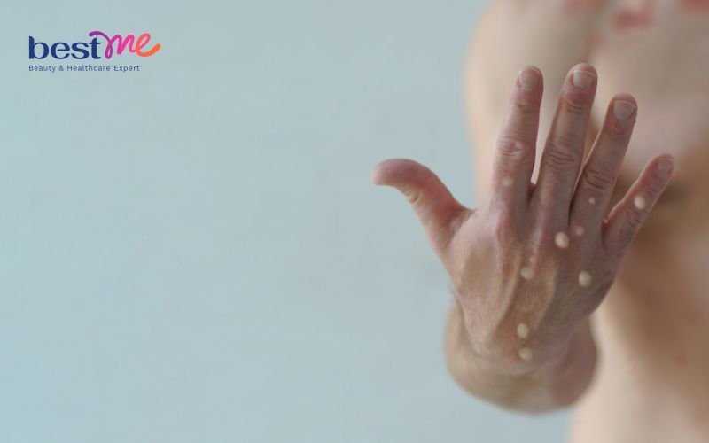 noi-mun-nhot-o-tay-phai-lam-sao-cach-tri-hieu-qua-triet-de-1 Nổi mụn nhọt ở tay phải làm sao? Cách trị hiệu quả triệt để - 1