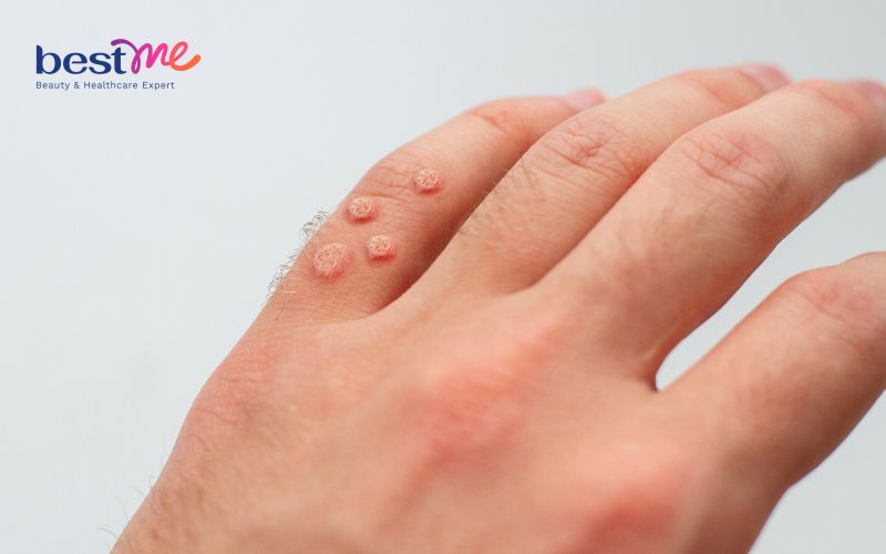 noi-mun-nhot-o-tay-phai-lam-sao-cach-tri-hieu-qua-triet-de-2 Nổi mụn nhọt ở tay phải làm sao? Cách trị hiệu quả triệt để - 2