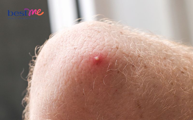 noi-mun-nhot-o-tay-phai-lam-sao-cach-tri-hieu-qua-triet-de-3 Nổi mụn nhọt ở tay phải làm sao? Cách trị hiệu quả triệt để - 3
