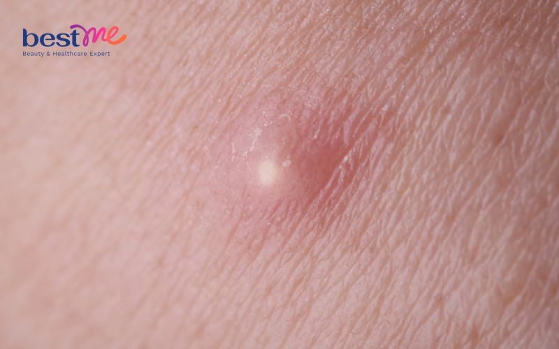noi-mun-nhot-o-tay-phai-lam-sao-cach-tri-hieu-qua-triet-de-4 Nổi mụn nhọt ở tay phải làm sao? Cách trị hiệu quả triệt để - 4