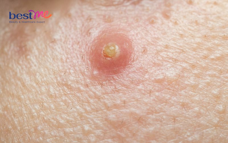 noi-mun-nhot-o-tay-phai-lam-sao-cach-tri-hieu-qua-triet-de-5 Nổi mụn nhọt ở tay phải làm sao? Cách trị hiệu quả triệt để - 5