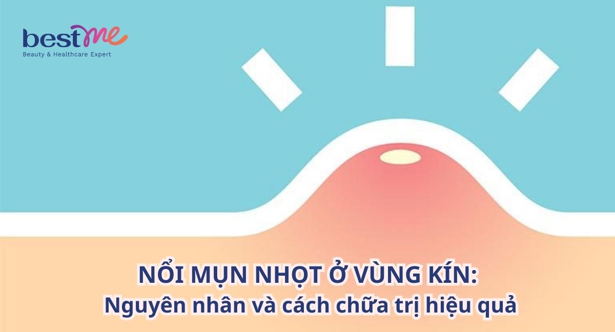 Nguyên nhân bị nổi mụn nhọt ở vùng kín và cách chữa tốt nhất